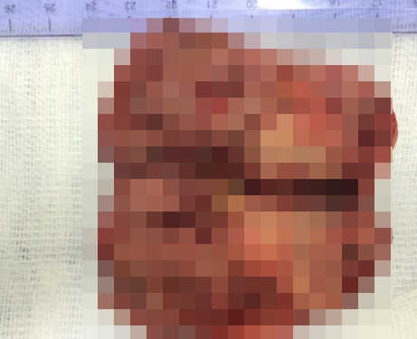 ung thư gan ảnh 1 ung thu gan anh 1