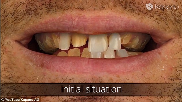 Cong nghe chinh rang moi hinh anh