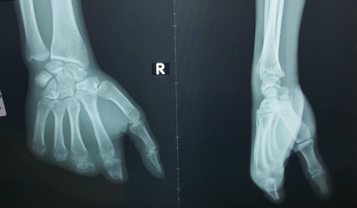 Dung ngon chan ghep thanh ngon tay cho chang trai mien Tay hinh anh