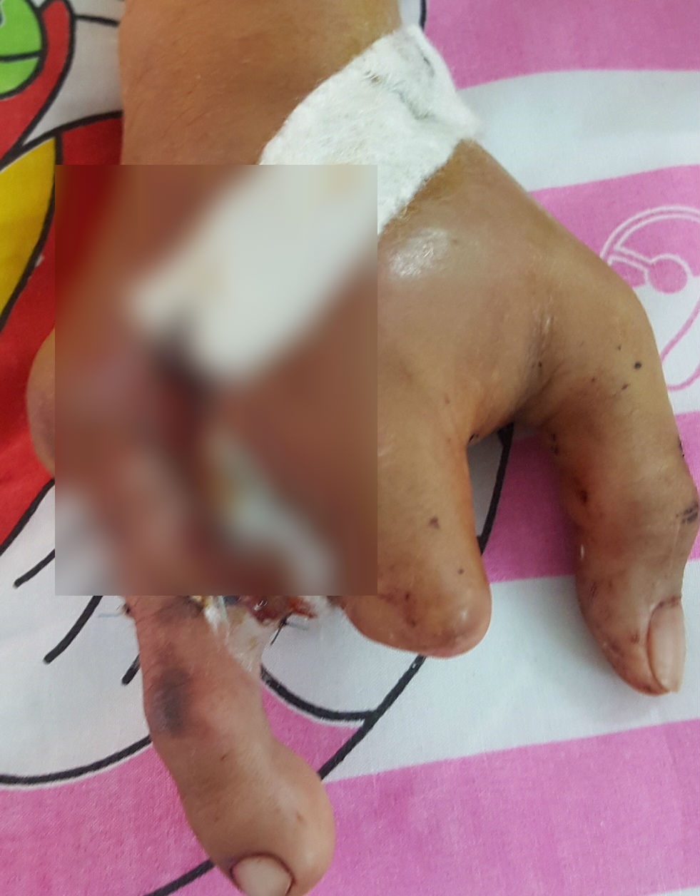 biến ngón chân thành ngón tay ảnh 1 bien ngon chan thanh ngon tay anh 1