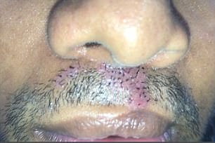 Cay ria mep che vet seo o moi hinh anh