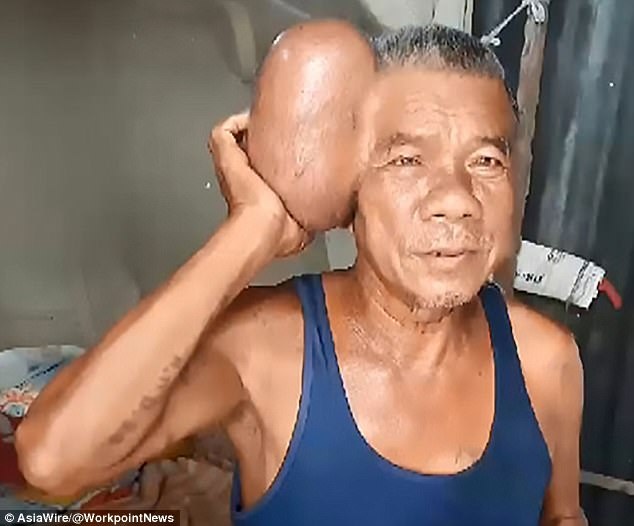 Nguoi dan ong co khoi u to nhu qua bong tren dau hinh anh