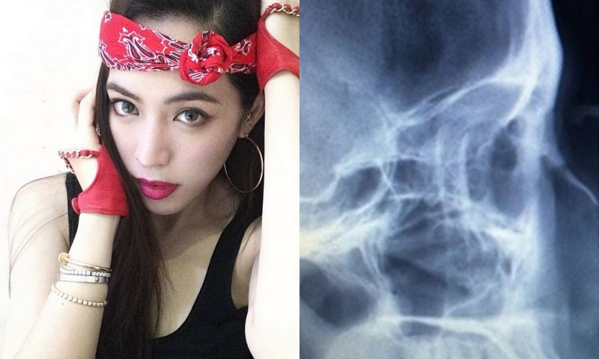 Ảnh chụp x-quang Arissa Cheo tung lên mạng, khẳng định mình không dao kéo.