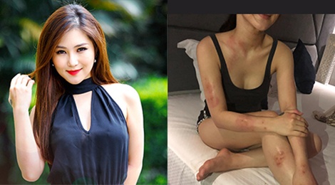 Huong Tram bi di ung cap tinh, noi tung mang khap nguoi hinh anh