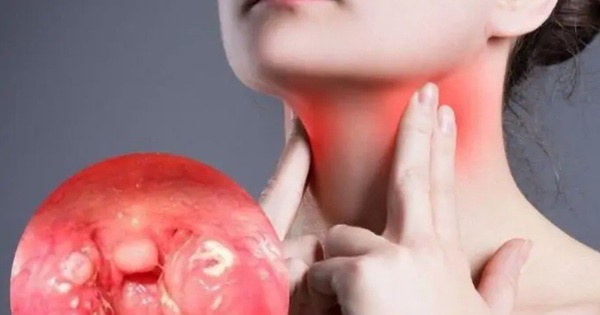 Viem hong cap co the gay ra bien chung gi? hinh anh