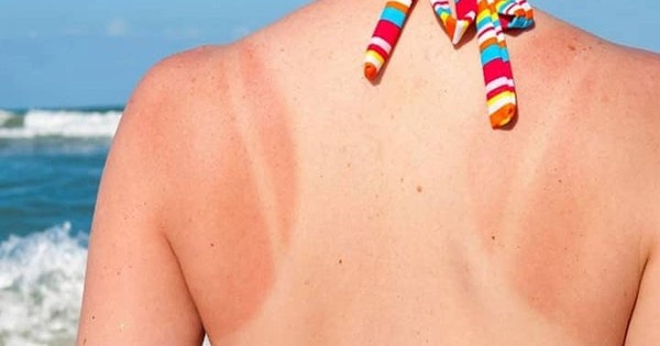 Cach phuc hoi lan da sau ram nang mua he hinh anh