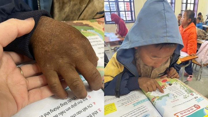 Ban tay nut ne cua cau be 8 tuoi vung cao khien trieu nguoi nghen lai hinh anh