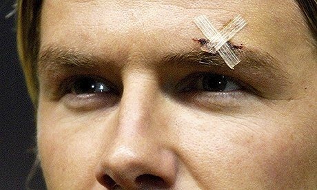 Sir Alex sút giày vào mặt Beckham ảnh 1 Sir Alex sut giay vao mat Beckham anh 1