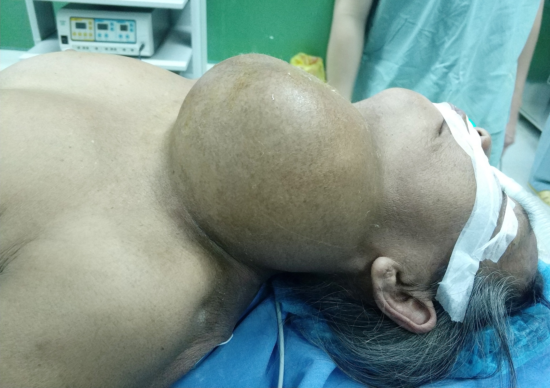 Cat bo khoi u khung nam tren co nu benh nhan 68 tuoi hinh anh