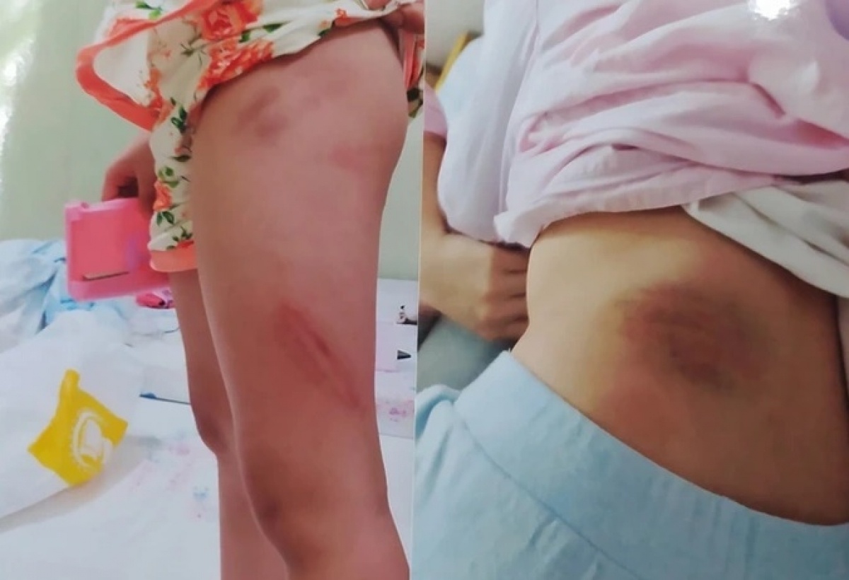 Hai chau be nghi bi bao hanh den nhap vien o Ha Noi hinh anh