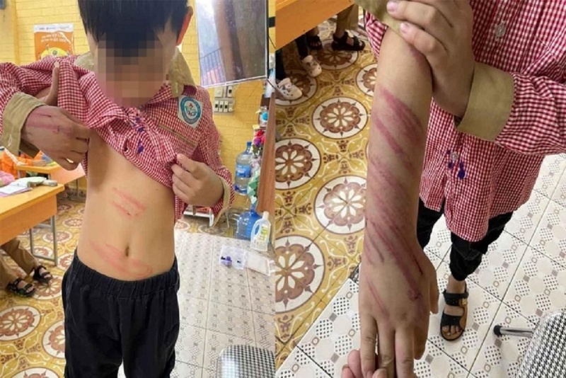 Loi khai bo duong bao hanh be trai 8 tuoi hinh anh