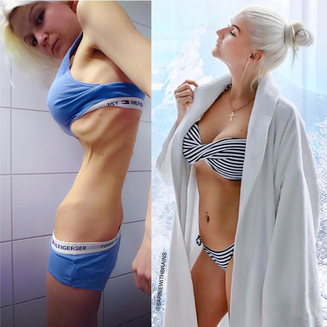 bệnh chán ăn ảnh 3 benh chan an anh 3