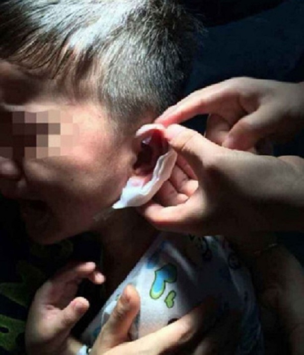 Nạn nhân khóc vì đau trong khi bác sĩ rút ghim khỏi tai bé. Ảnh: Weibo