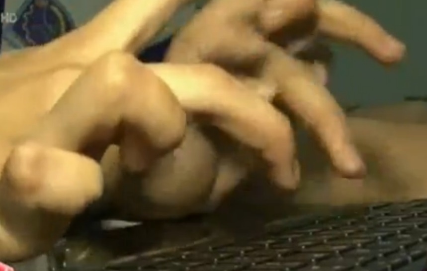 Nu sinh hoc nganh may tinh voi doi tay khuyet tat hinh anh