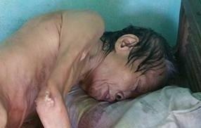 Cu ba mu cut chan thoi thop vi vet thuong lo loet hinh anh
