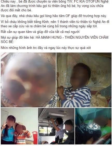 Cậu bé bỏng toàn bộ mặt ảnh 1 Cau be bong toan bo mat anh 1