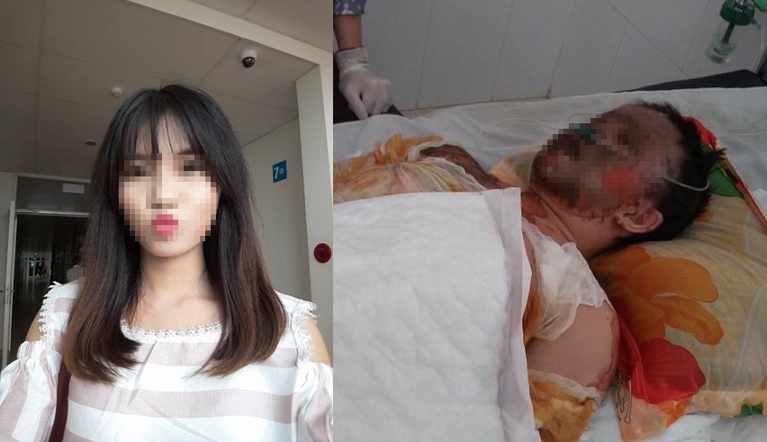 cô gái nguy kịch vì bỏng nặng ảnh 1 co gai nguy kich vi bong nang anh 1