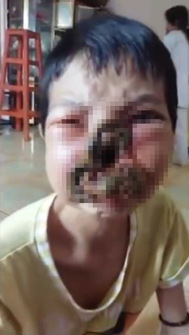cô gái bị ăn mòn nửa khuôn mặt ảnh 1 co gai bi an mon nua khuon mat anh 1