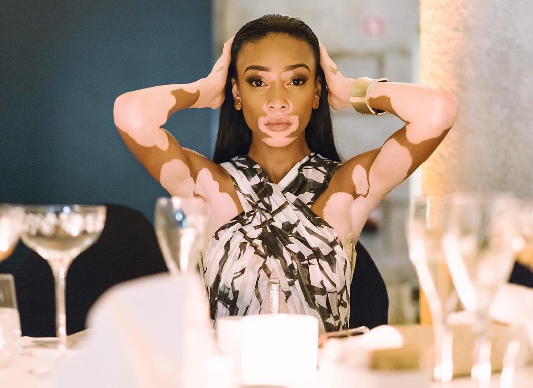 người mẫu da loang lổ ảnh 2 nguoi mau da loang lo anh 2