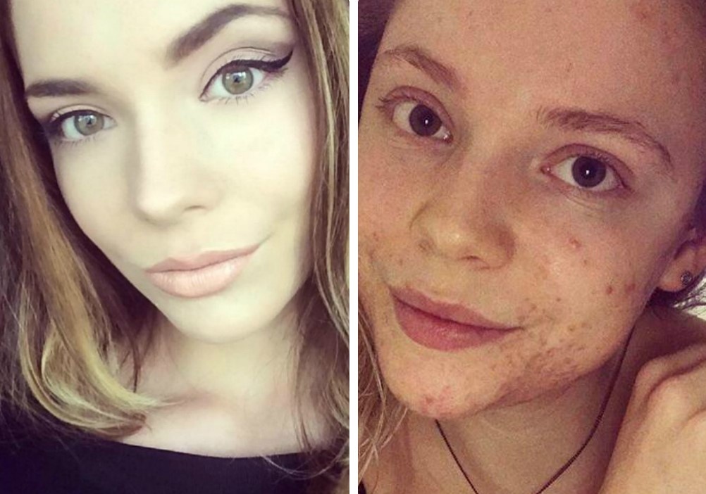 Hot girl Anh bat ngo khoe mat moc day mun, tu tin thi hoa hau hinh anh