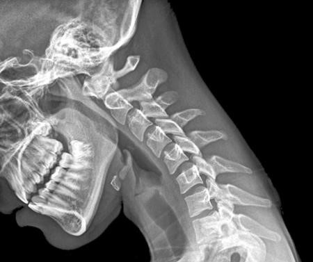 cô bé hỏng cổ vì dùng điện thoại ảnh 2 co be hong co vi dung dien thoai anh 2