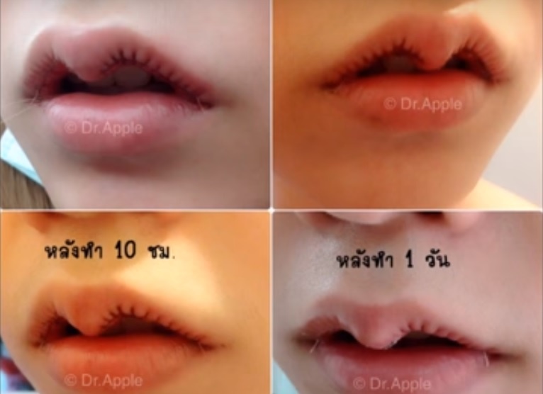 Tham my 'moi sung trau' khien gioi tre trong nhu ma, khong dam cuoi hinh anh