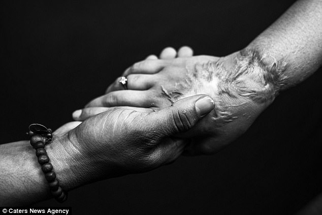 nạn nhân tạt axit ảnh 3 nan nhan tat axit anh 3