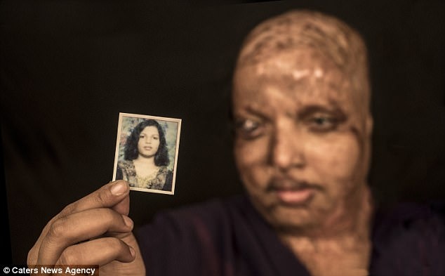 nạn nhân tạt axit ảnh 1 nan nhan tat axit anh 1