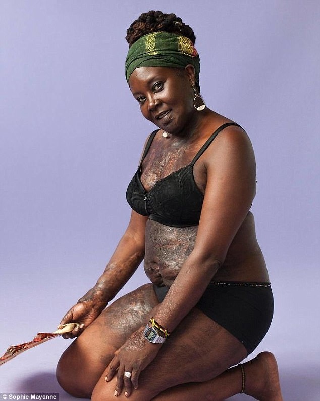 nhung co gai chia se cau chuyen sau vet seo anh 4