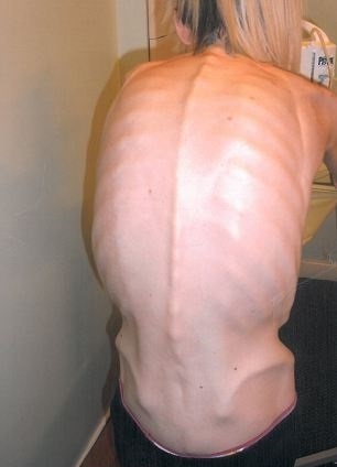 cô gái 19 kg biến đổi sau khi sinh con ảnh 2 co gai 19 kg bien doi sau khi sinh con anh 2