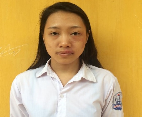 Nu sinh kho so vi vet cham tren mat anh 1