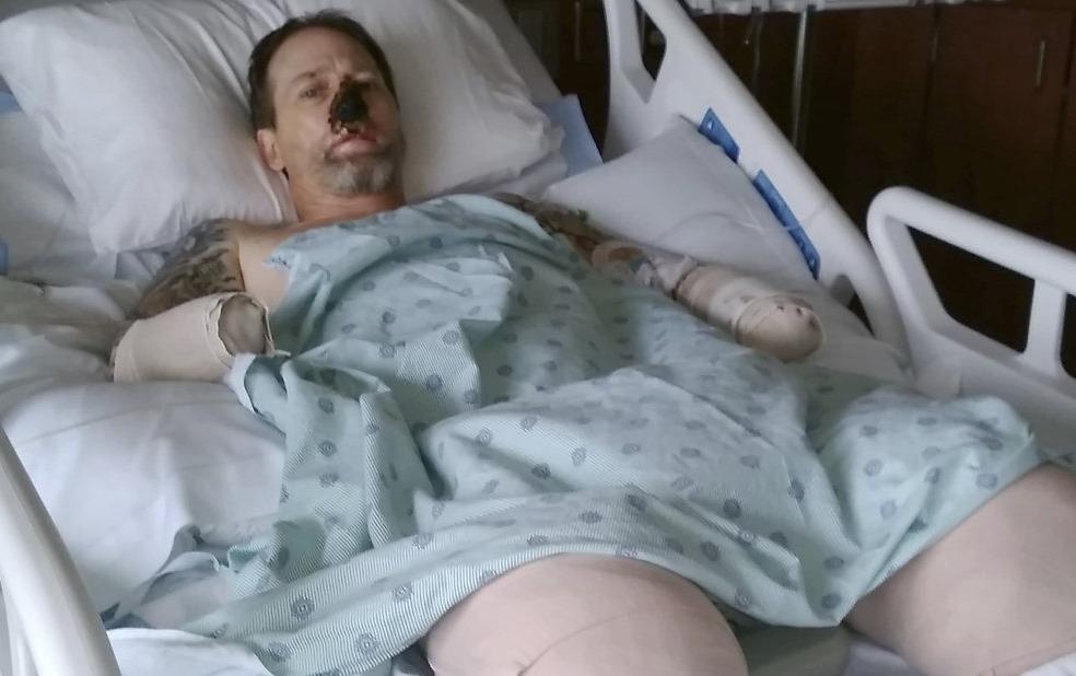 Nguoi dan ong My phai cat tu chi vi benh nghi lay tu cho cung hinh anh