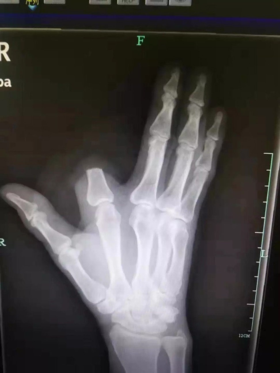 chat dut ngon tay vi ran can anh 1