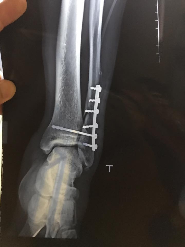 Dương Văn Hào, gãy xương mác, hạng Nhất quốc gia, CLB Viettel, Huỳnh Tấn Tài, ảnh 1 Duong Van Hao, gay xuong mac, hang Nhat quoc gia, CLB Viettel, Huynh Tan Tai, anh 1