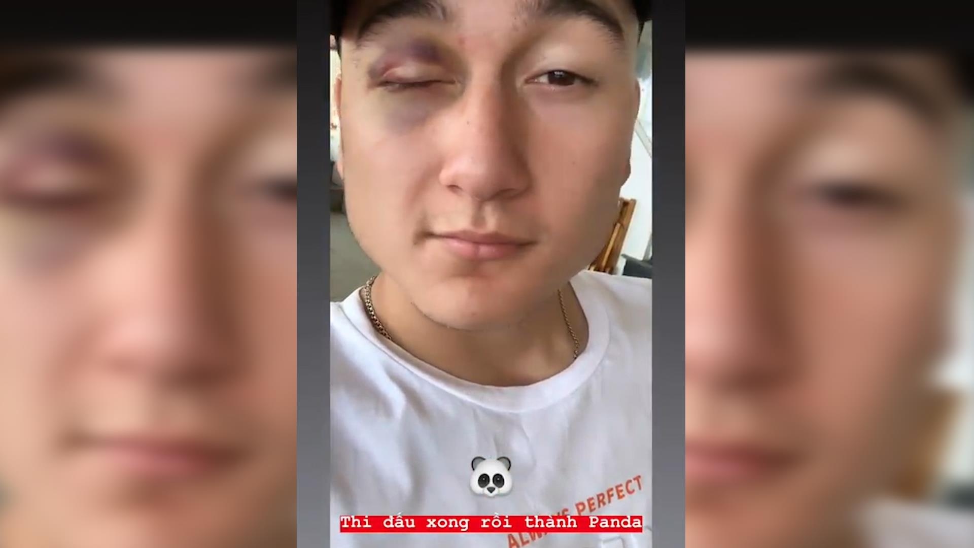 Van Lam khoe bi tham mat sau tran dau hinh anh