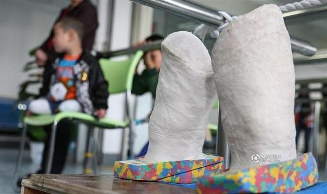 Cậu bé đã không khóc khi nhìn thấy bác làm một khuôn mẫu silicon cho chân giả của mình như lúc được quấn vải thạch cao.