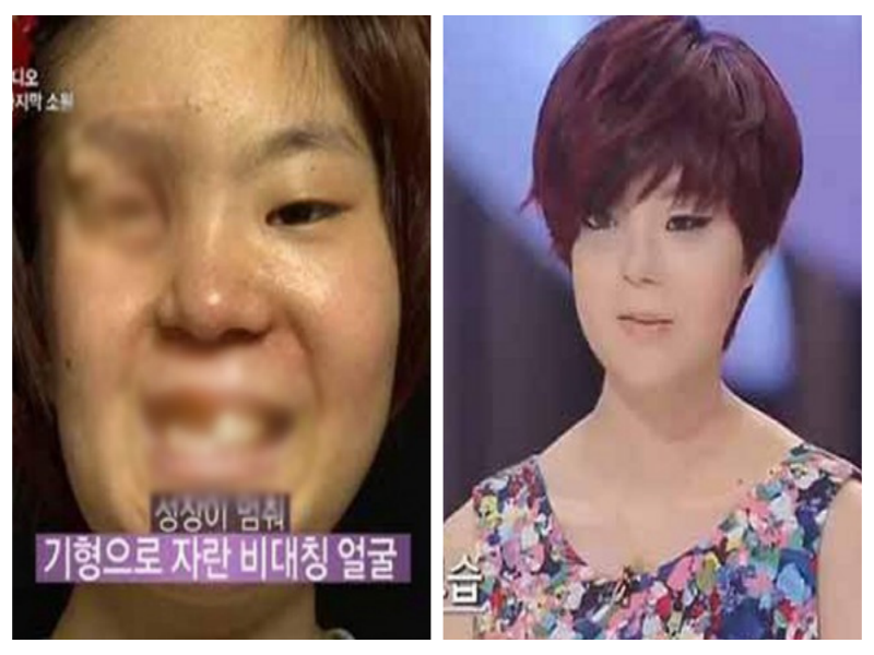 'Co gai nua mat' tim lai cuoc doi nho phau thuat tham my hinh anh