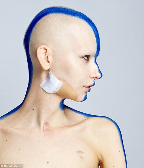 Elizaveta đã phải trải qua một cuộc phẫu thuật kéo dài 16 tiếng để loại bỏ khối u và khu vực xung quanh. Kết cục, cô phải cắt đi tới 95% xương hàm của mình. Các bác sĩ đã sử dụng một phần xương mác từ chân phải của cô, cùng phần da ở một số bộ phận cơ thể khác để tái tạo xương hàm cho Elizaveta.