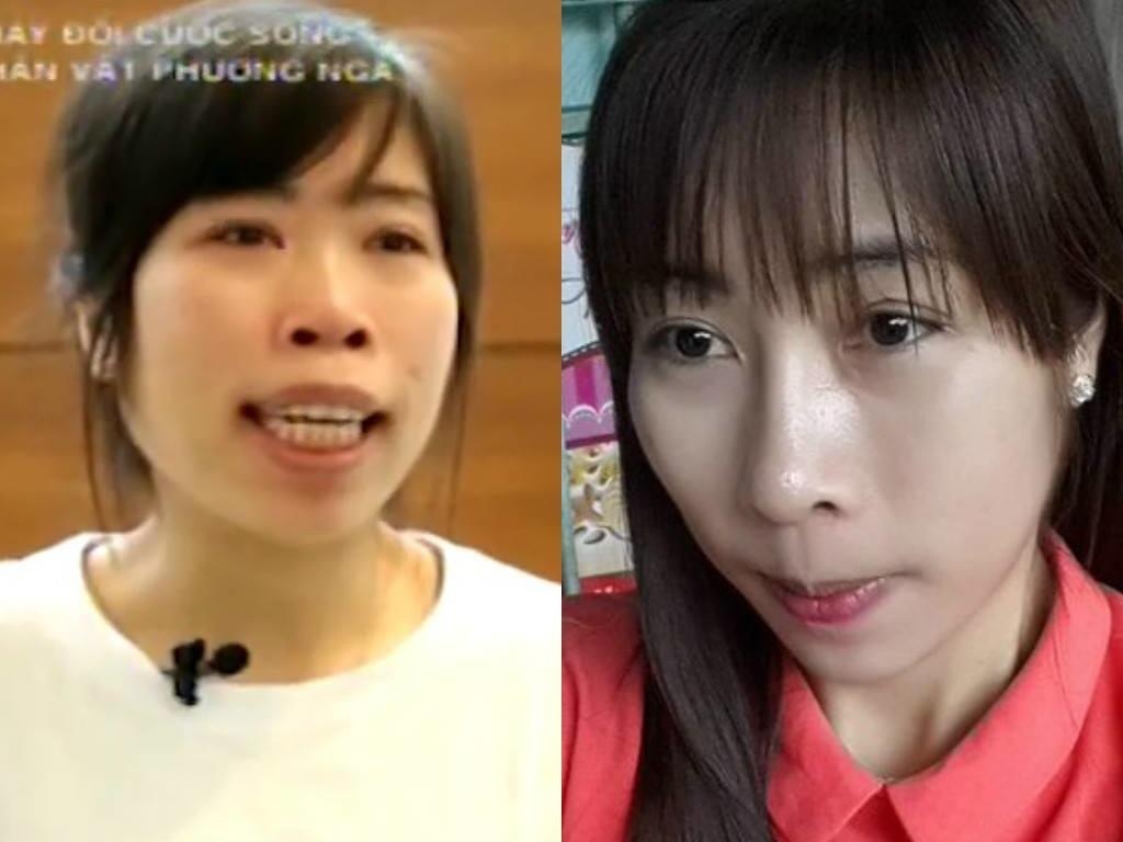 Co gai dao keo khuon mat sau khi gia dinh nguoi yeu choi bo hinh anh