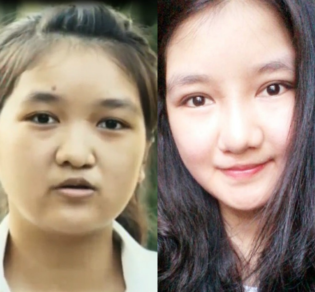 Co gai sut moi doi doi nho phau thuat tham my hinh anh
