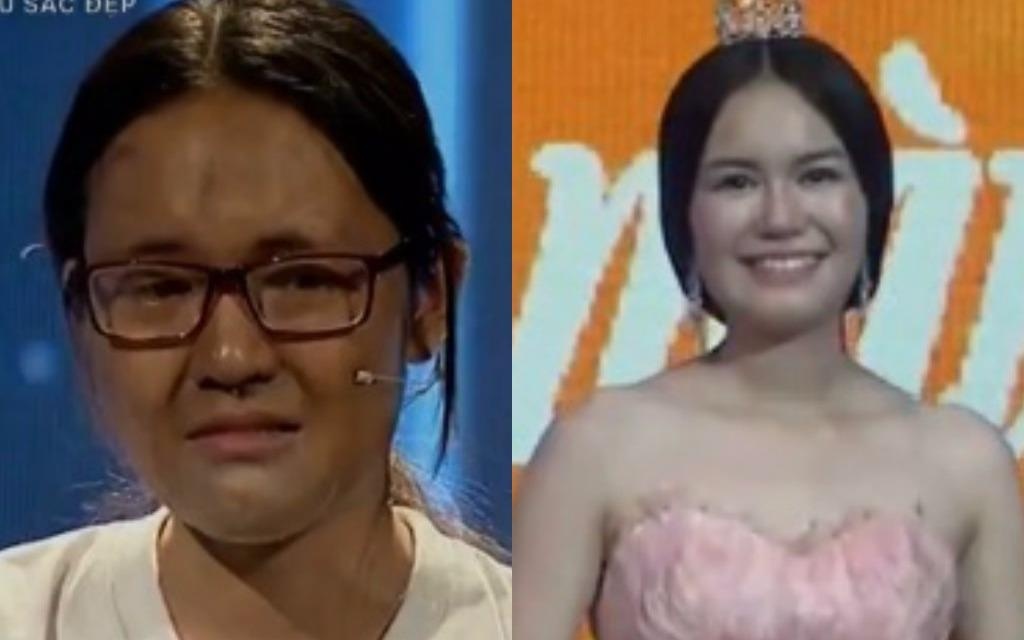 Nu sinh Thuong mai bi mom xinh dep sau nhieu lan dao keo hinh anh