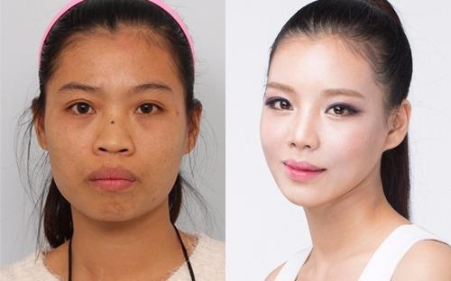 Co gai 26 tuoi tre hoa sau nhieu lan dao keo hinh anh