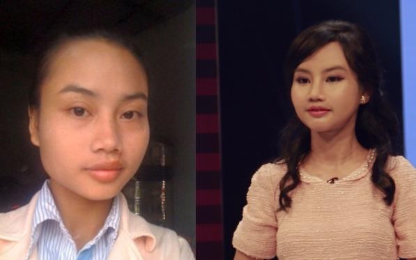 Co gai bi seo giua mat xinh dep sau phau thuat tham my hinh anh