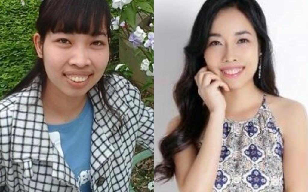 Co gai doi doi nho phau thuat chinh ham ho hinh anh