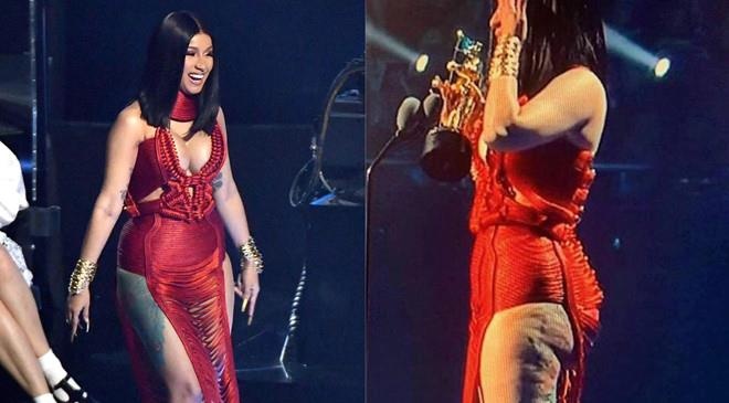 Doi chan Cardi B bi bien dang loi lom do phau thuat tham my hinh anh