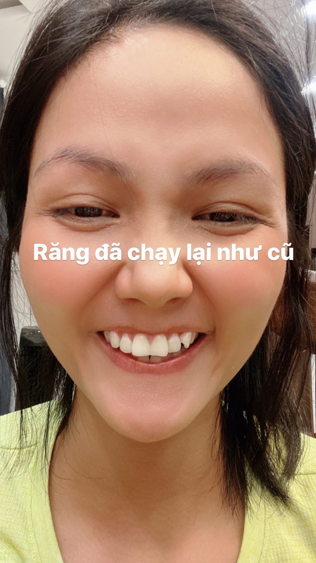 h'hen niê niềng răng ảnh 2 h'hen nie nieng rang anh 2