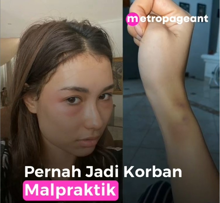 hoa hau hoan vu indonesia bi bong anh 1