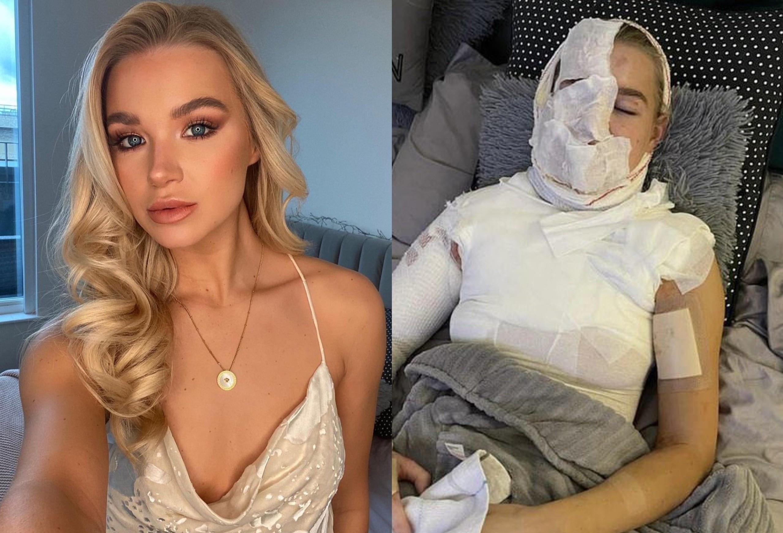 Vu cong Anh phau thuat 3 lan vi bi bong nang hinh anh