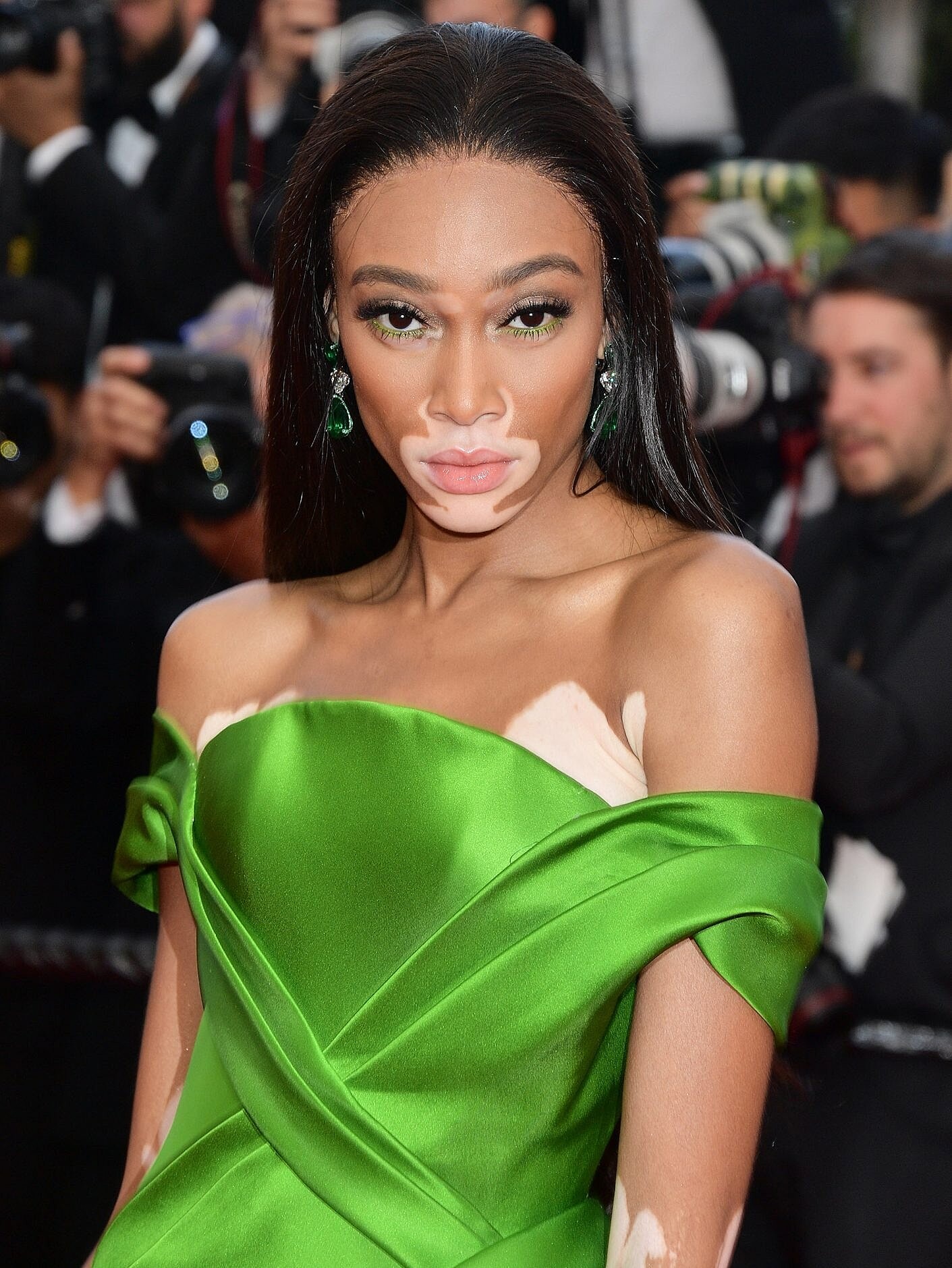 sao hollywood mắc bệnh bạch biến ảnh 2 sao hollywood mac benh bach bien anh 2