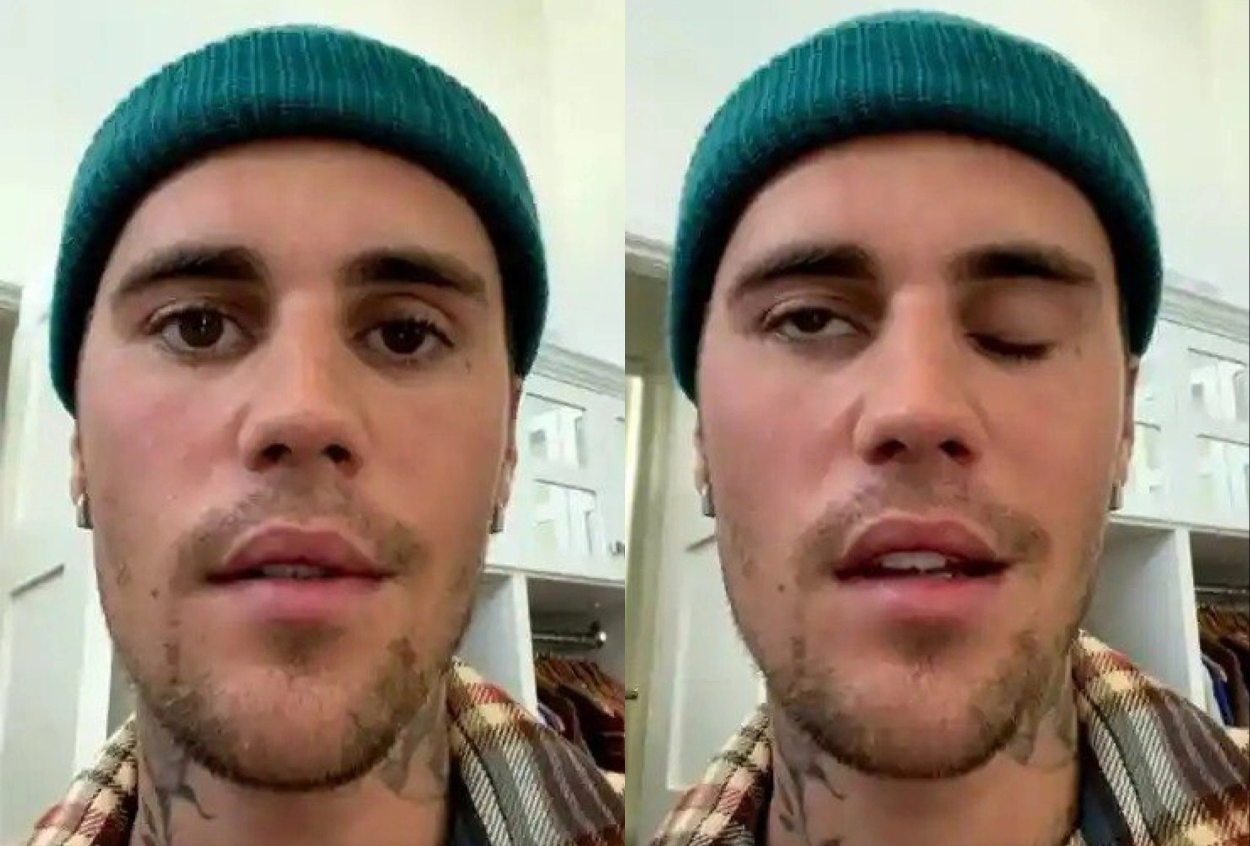 Justin Bieber bi liet co mat hinh anh